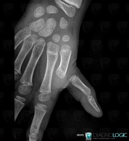 Dislocation, Thumb, Metacarpophalangeal joints, X rays