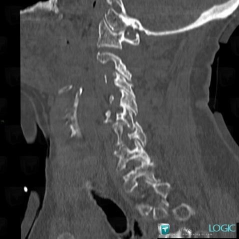 Dislocation, Vertebral body / Disk, CT