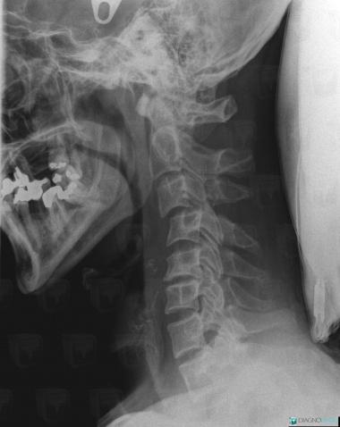 Radiology case : Dislocation (CT ,X rays) - Diagnologic