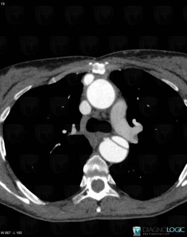 Dissection aortique, Aorte, Scanner