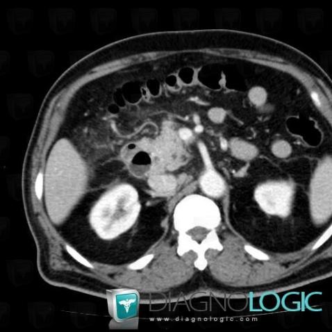 Diverticule, Duodénum, Scanner