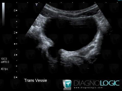 Diverticule, Vessie, Echographie