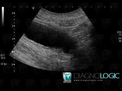 Diverticule-vessie, Vessie, Echographie