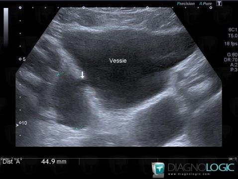 Diverticule-vessie, Vessie, Pelvis / Périnée, Echographie