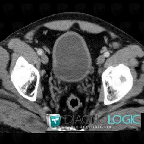 Diverticule-vessie, Vessie, Scanner