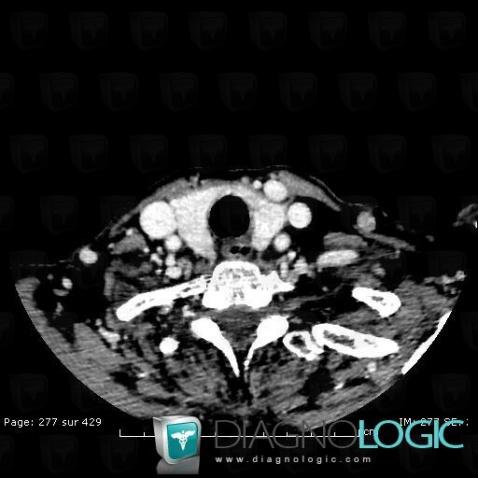 Diverticule-Zenker, Pharyngolarynx, Espaces profonds-cou, TDM