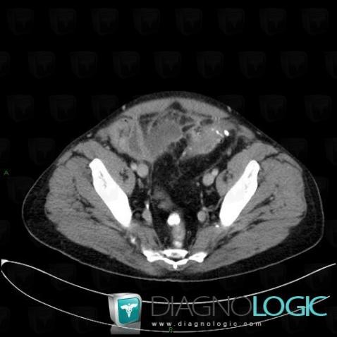 Diverticulite sigmoïdienne, Colon, Scanner