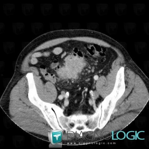 Cas radiologie : Cancer du sigmoïde (Scanner) - Diagnologic