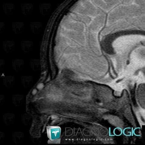 Dorsal nasal cyst, Nasal cavity / Nasopharynx, MRI