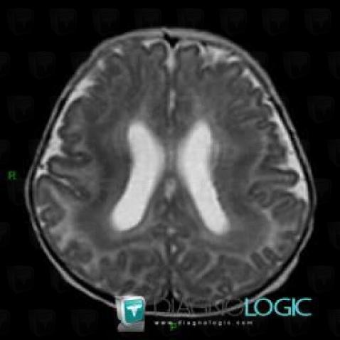 Double cortex syndrome, Cortico subcortical region, Cerebral hemispheres, MRI