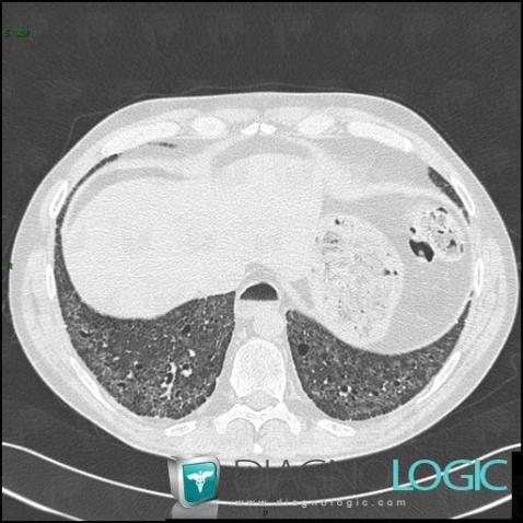 Drug induced pulmonary fibrosis, Pulmonary parenchyma, CT