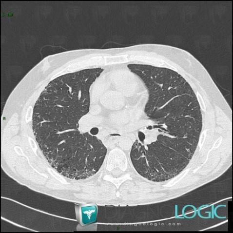 Drug induced pulmonary fibrosis, Pulmonary parenchyma, CT