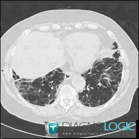 Drug induced pulmonary fibrosis, Pulmonary parenchyma, CT