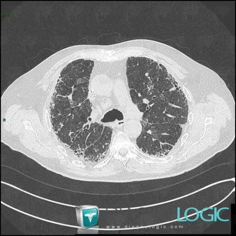 Drug induced pulmonary fibrosis, Pulmonary parenchyma, CT