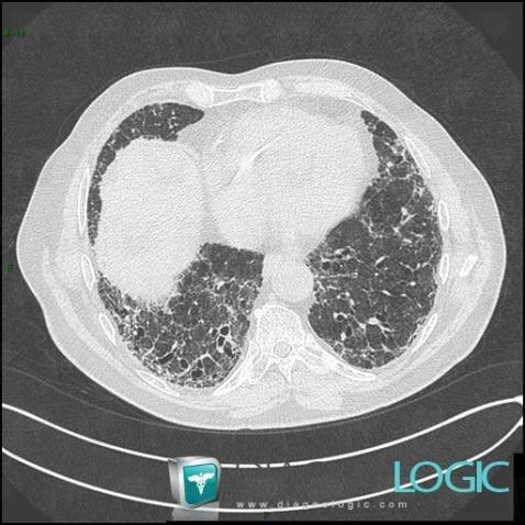 Drug induced pulmonary fibrosis, Pulmonary parenchyma, CT