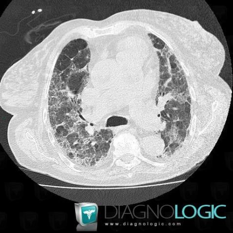 Drug induced pulmonary fibrosis, Pulmonary parenchyma, CT