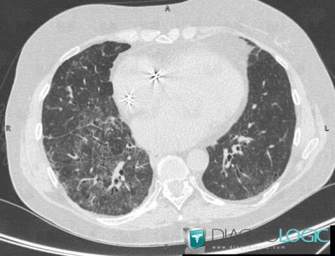 Drug induced pulmonary fibrosis, Pulmonary parenchyma, CT