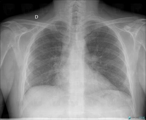 Drug induced pulmonary fibrosis, Pulmonary parenchyma, X rays