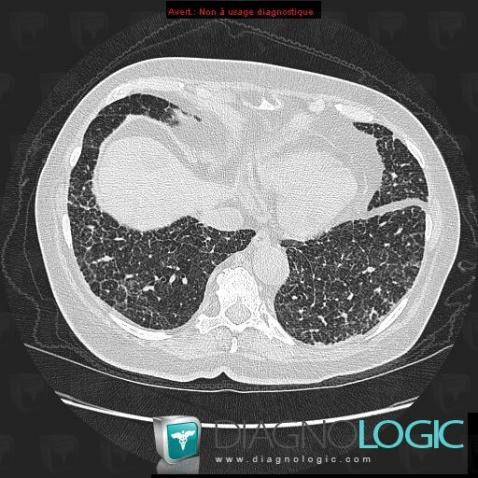 Radiology case : Drug induced pulmonary toxicity (CT) - Diagnologic