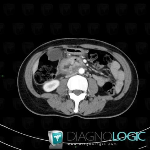 Duodenal adenocarcinoma, Duodenum, CT