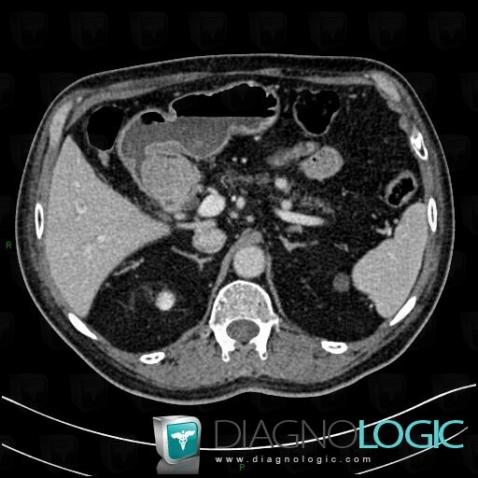 Duodenal adenocarcinoma, Duodenum, CT