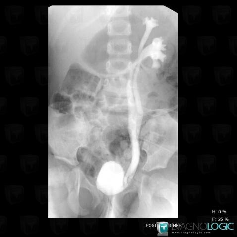 Duplicated collecting system, Collecting system, Ureter, X rays