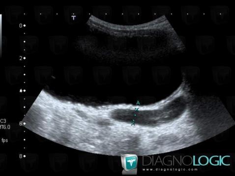 Duplicated collecting system, Ureter, US