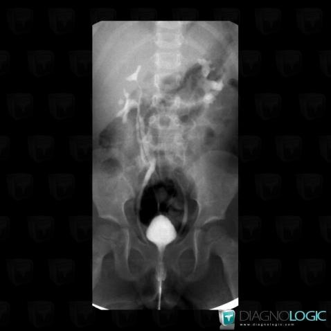 Duplicated collecting system, Ureter, X rays