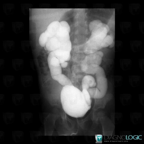 Duplicated collecting system, Ureter, X rays