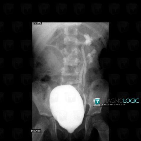 Duplicated collecting system, Ureter, X rays