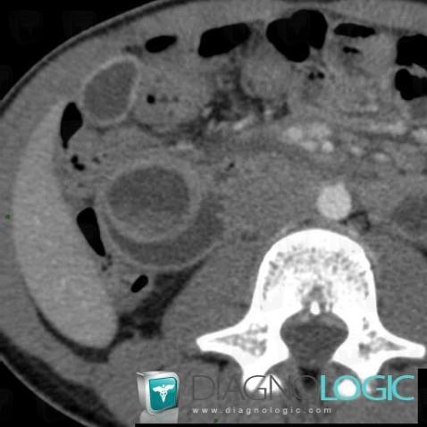 Duplication cyst, Duodenum, CT