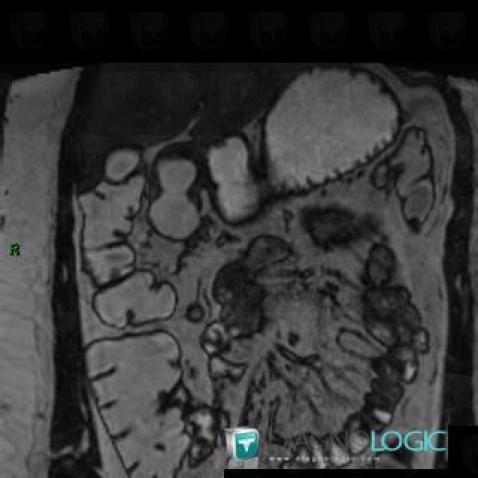 Duplication cyst, Duodenum, MRI