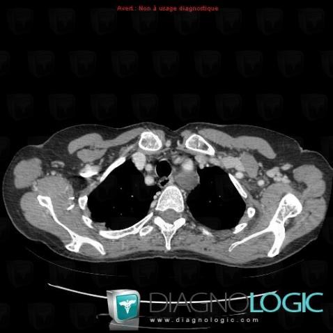 Duplication cyst, Mediastinum, CT