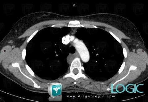 Duplication cyst, Mediastinum, Paraspinal, CT