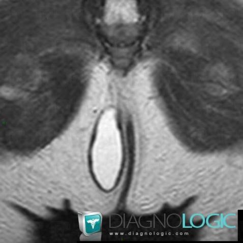 Duplication cyst, Rectum, MRI