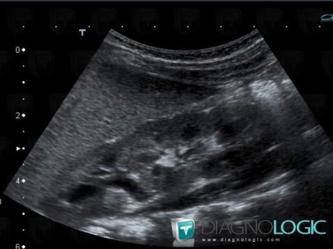 Duplication-voies excrétrices, Système collecteur, Uretère, Echographie