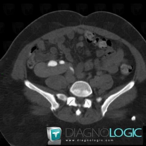 Duplication-voies excrétrices, Uretère, Scanner