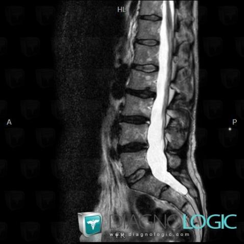 Dural ectasia, Vertebral body / Disk, MRI