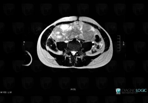 Dysgerminoma, Adnexa / Ovary fallopian tube, MRI