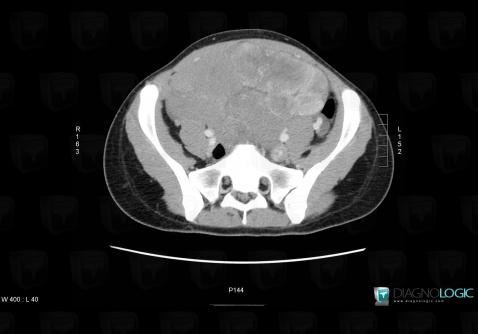 Dysgerminoma, Adnexa / Ovary fallopian tube, Pelvis / Perineum, CT