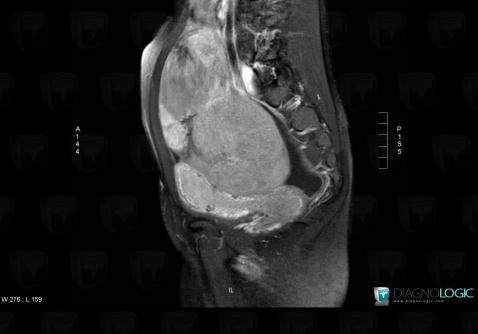 Dysgerminoma, Adnexa / Ovary fallopian tube, Pelvis / Perineum, MRI