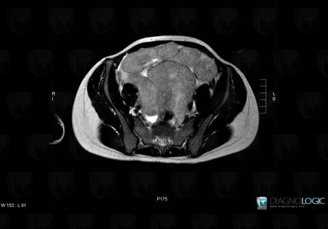 Dysgerminoma, Adnexa / Ovary fallopian tube, Pelvis / Perineum, MRI