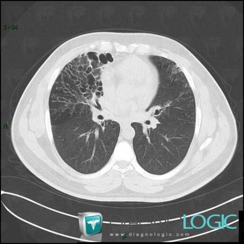Dyskinetic cilia Syndrome, Airways, CT