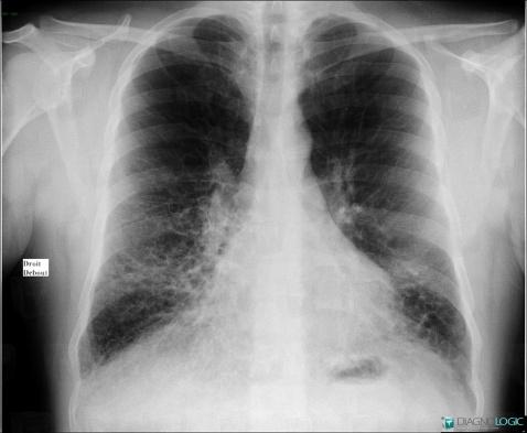 Dyskinetic cilia Syndrome, Airways, X rays