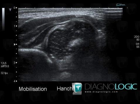 Dysplasie congénitale-hanche, Articulation coxo fémorale, Echographie