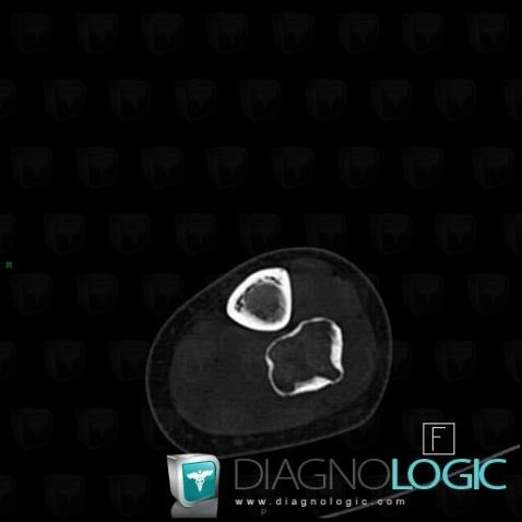 Dysplasie fibreuse, Fibula -moyen, Scanner
