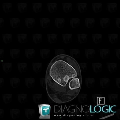 Dysplasie fibreuse, Fibula -supérieur, Tibia -inférieur, Scanner