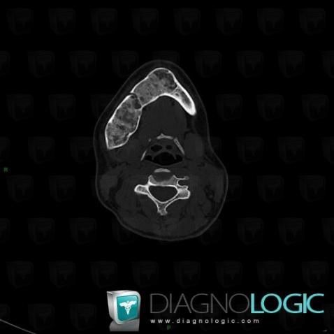 Dysplasie fibreuse, Mandibule, Scanner