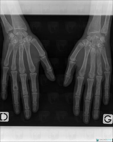Dysplasie fibreuse, Métacarpiens, Phalanges / Os sésamoides - Main, Radio