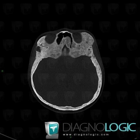 Dysplasie fibreuse, Os-l orbite, Scanner
